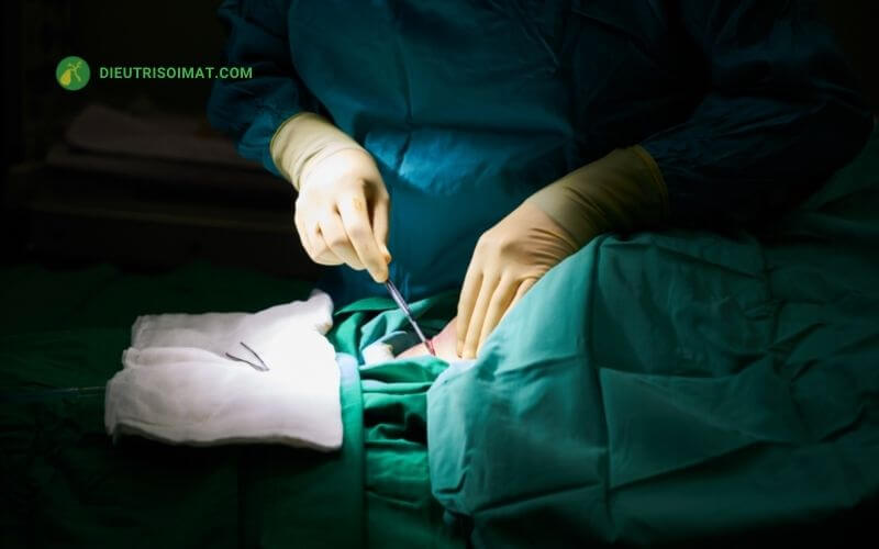 Điều trị sỏi túi mật bằng phẫu thuật